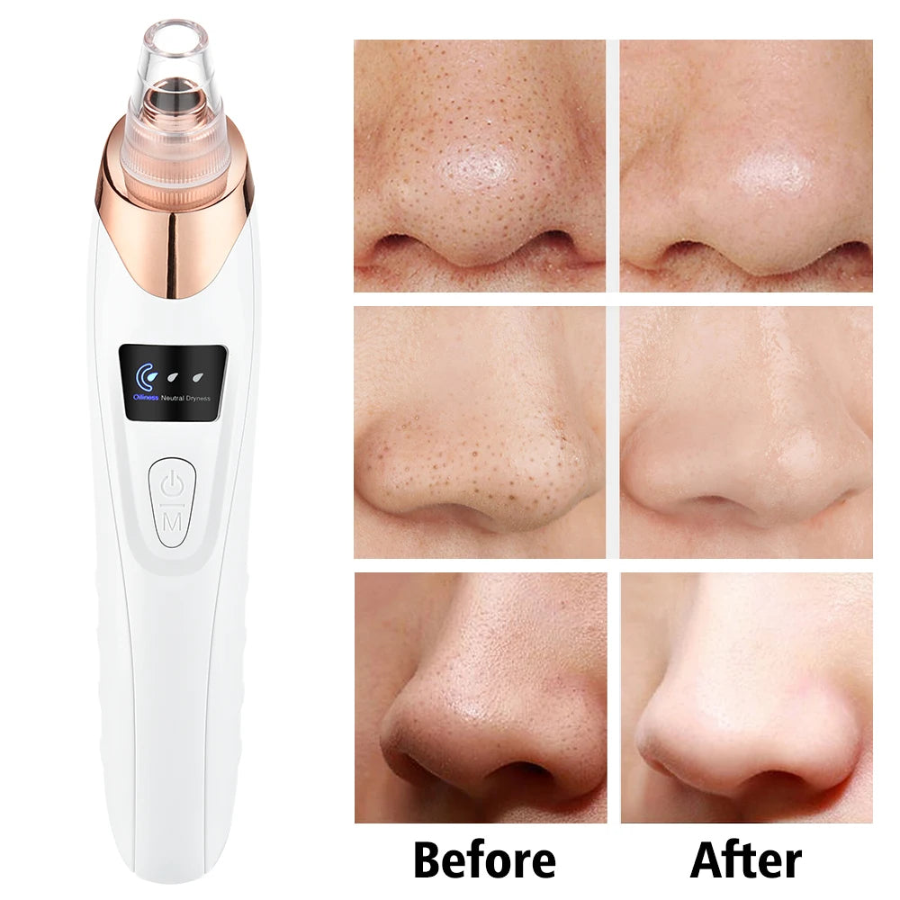 Electric Vacuum Suction Blackhead