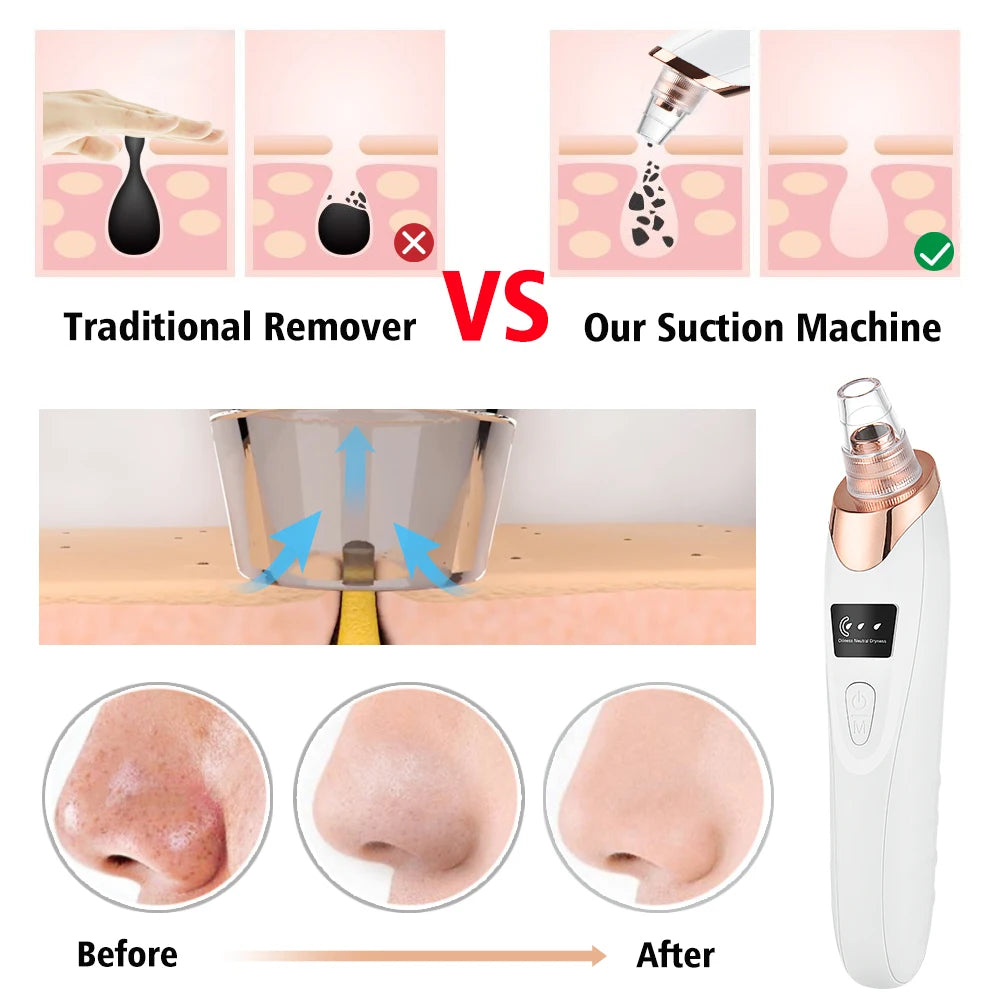 Electric Vacuum Suction Blackhead